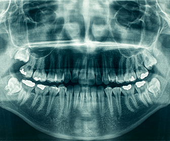 donde-radiografia-panoramica-dental