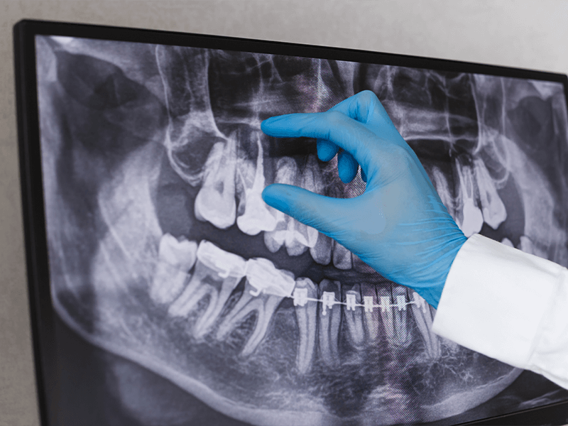 rayos-x-dental-precio-y-beneficios-conocelos