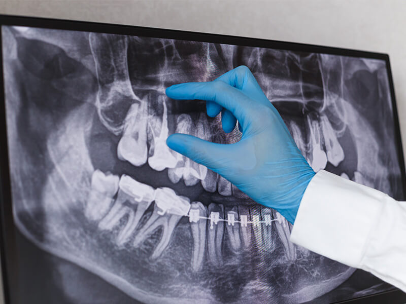 que-es-la-planificacion-de-implantes-en-odontologia-previa-dental-works-tijuana