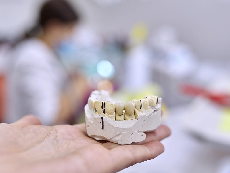fundas-dentales-de-porcelana-una-excelente-opcion-para-ti-previa-dental-works-tijuana