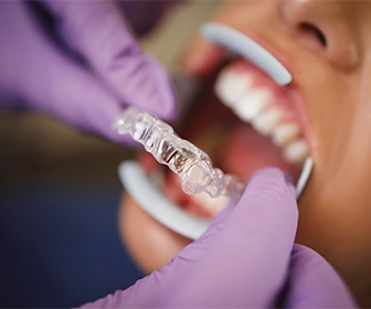 invisalign-ha-revolucionado-la-ortodoncia-y-hoy-en-dia-se-ha-convertido-en-una-de-las-opciones-favoritas-de-los-pacientes-previa-mx