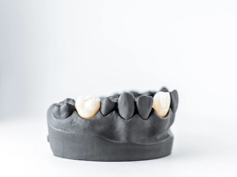 cuantos-dientes-se-pueden-poner-por-implante-descubrelo