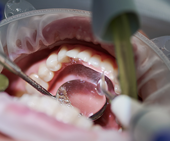 importancia-de-la-profilaxis-dental